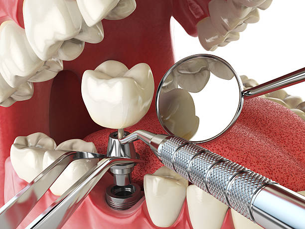 Best Emergency Wisdom Tooth Extraction in Mineville, NY